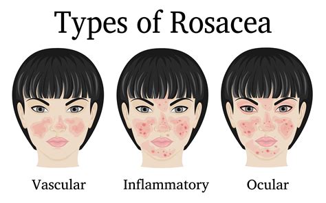 Rosacea Advanced Skin And Laser Center