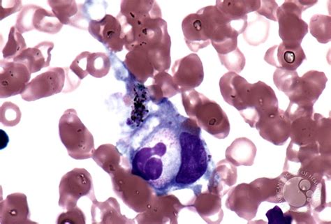 Familial Hemophagocytic Lymphohistiocytosis 2