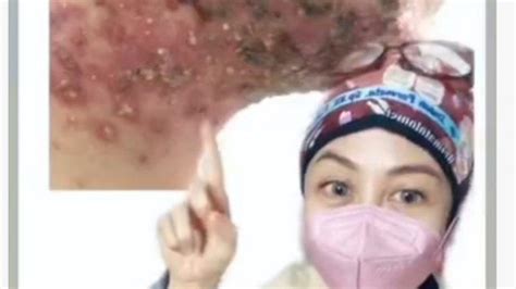 Sesudah pecah biasanya jerawat maupun bisul biasanya lama untuk. Bawang Putih Tak Boleh Dioles ke Wajah Apalagi Untuk ...