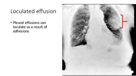 In a subgroup of patients who have heavily septated or loculated malignant effusions, pleurodesis is less. Pleural effusion(X-ray Findings)