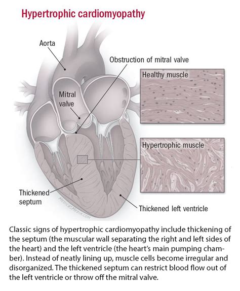 Cardiomyopathy Symptoms Diagnosis And Treatment Harvard Health