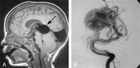 Vein Of Galen Aneurysmal Malformation Diagnosis And Treatment Of 13