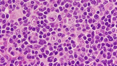 This disease is characterized by the presence of sternberg cells (rs) is an examination by microscope. Hodgkin lymphoma: CHL vs NLPHL - YouTube