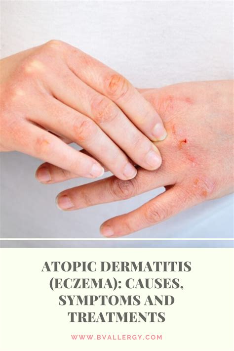 Atopic Dermatitis Eczema Causes Symptoms And Treatments Atopic Dermatitis Atopic