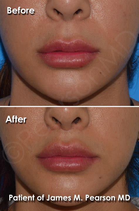 lip lift photos before and after dr james pearson facial plastic surgery
