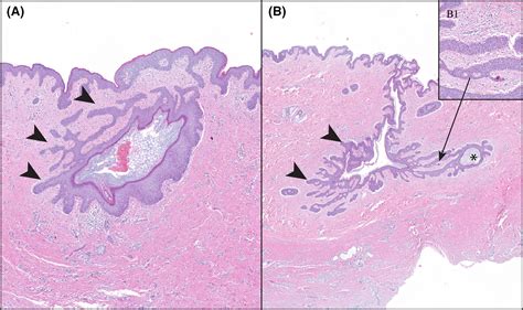Histologic Progression Of Acne Inversahidradenitis Suppurativa
