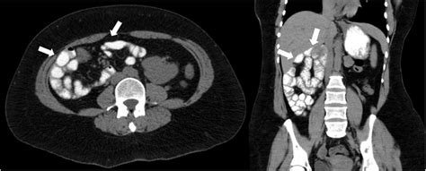 Axial And Coronal Ct Images With Barium Oral Contrast Of Our Patient