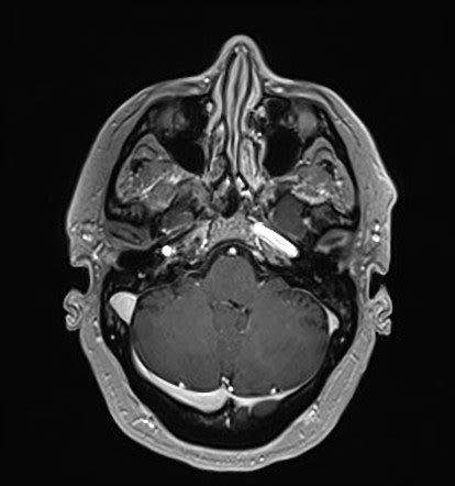 Right Facial Nerve Neuritis Radiology Case Radiopaedia Org