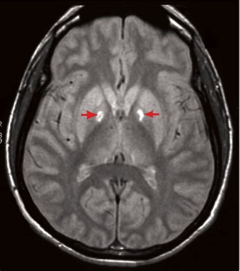 Brain Mri Could Predict Strokes In Asymptomatic Patients