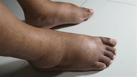 What Causes Swollen Feet Bansal Global Hospital