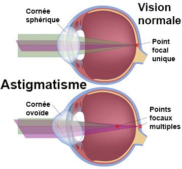 Grâce à des schémas, voyez la différence entre un œil astigmate et un œil emmetrope (œil sans défaut visuel). Astigmatisme : symptômes, traitement, définition ...