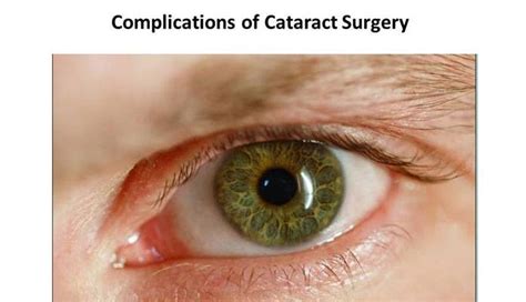 What Happens During The Cataract Surgery Procedure A