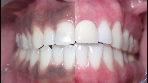 Remove Dark Gums With Water Youtube