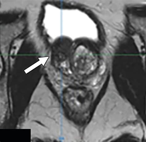 In Bore Transrectal Mriguided Biopsy With Robotic Assistance In The