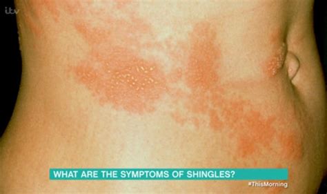 Nerves Affected By Shingles