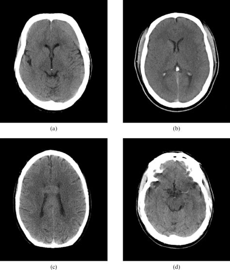 Four Representative Images From The Abnormal Series Of Head Ct Cases