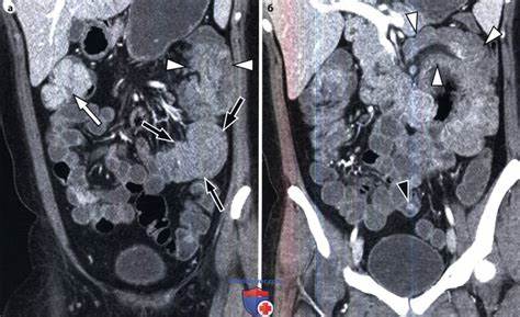 Диеты при тонкой кишки