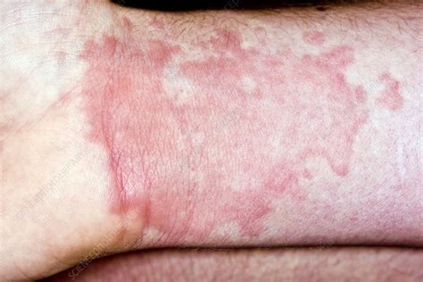 Urticaria Stock Image C Science Photo Library