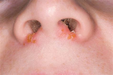 Impetigo Infection On Nose Photograph By Dr P Marazziscience Photo