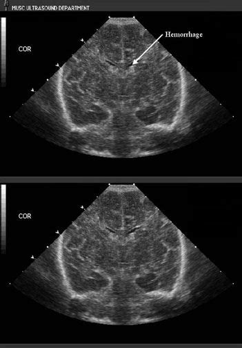 Intraventricular Hemorrhage Grade I Coronal View Ultrasound