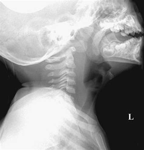 Retropharyngeal Abscess A Potentially Dangerous Condition Medizzy
