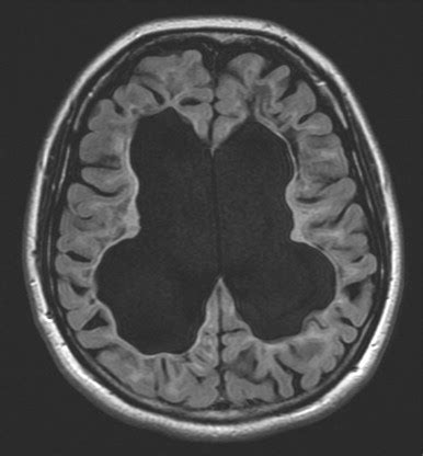 A study by researchers at children's national hospital provides direct evidence that targeting specific receptors in white matter cells after brain injury promotes. Vanishing White Matter Disease Presenting as Opsoclonus ...