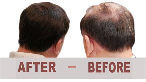 Mens Hair Loss Treatment Before And After A Nonsurgical Hair Replacement Youtube