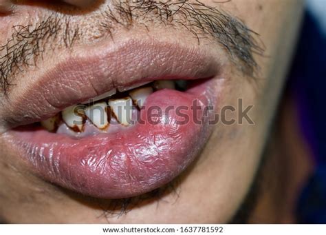 Mucous Cyst Mucocele Lower Lip Southeast Stock Photo Edit Now 1637781592