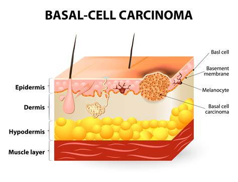 Squamous Cell Carcinoma Natural Treatment Quotes Sites