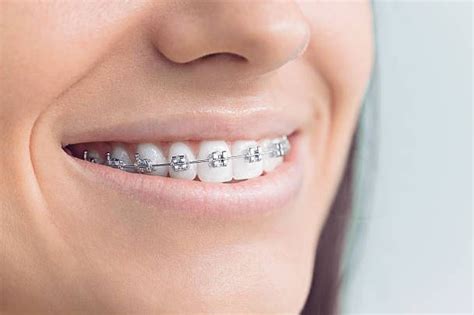 Cost Of Braces In South Africa 20232024 Informationngr