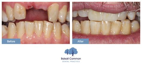 Dental Implants Treatment Balsall Common Dental