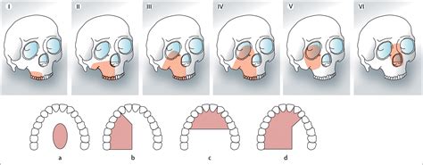 Reconstruction Of The Maxilla And Midface Introducing A New
