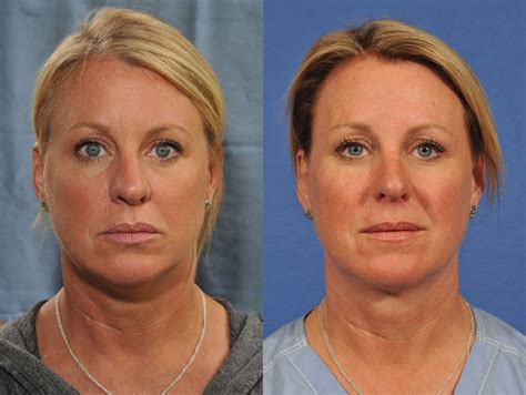 Kybella Before And After 2 Jesse E Smith Md Facs Ft Worth
