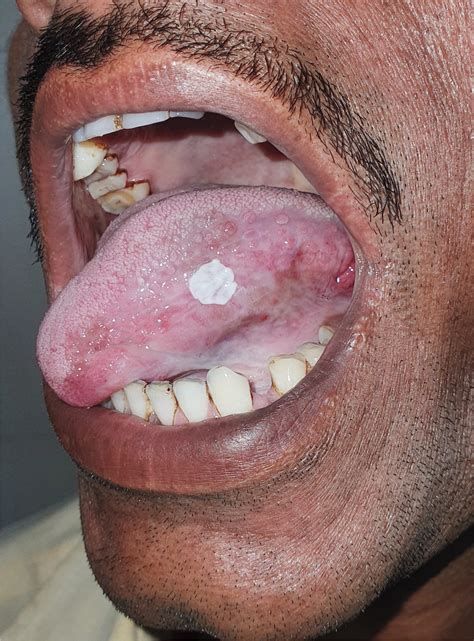 Round Spot On Tongue