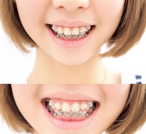 my braces story 2 put on braces damon braces system price and my experience