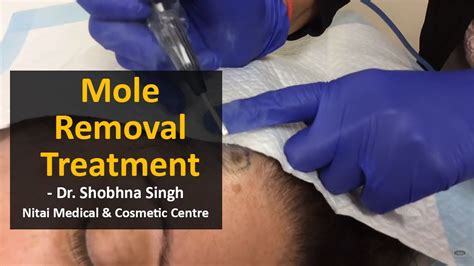 Mole Removal Treatment Using Ellman Machine Nitai Medical Melbourne