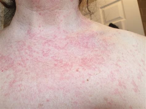 Experts Indicate Eight Types Of Skin Rash That Could Be A Symptom Of