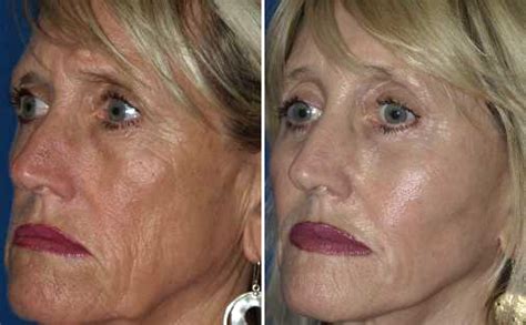 Co2 Laser Resurfacing Before And After Pictures Active Fx