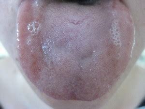 帯状疱疹の症例 陽虚 竜胆瀉肝湯 | 中医学アカデミー ブログ
