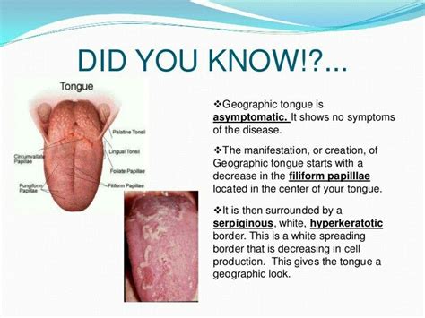 Geographic Tongue Awareness Geographic Tongue Geographic Tongue