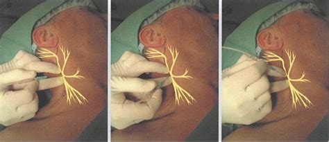 Cervical Plexus Block. | Anesthesia Key