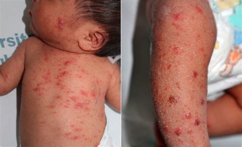 Scabies In A 4 Week Old Baby Boy A Diagnostic Challenge Archives Of