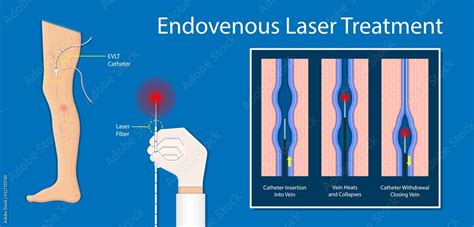 Endovenous Laser Treatment Cvd Treat Elt Legs Inject Evlt Varicose
