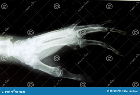 X Ray Image Of Healthy Normal Human Hand Stock Image Image Of