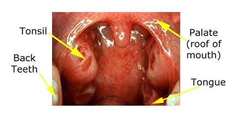 Medical Images Appearance Of Normal Tonsils And Inflamed Pharyngeal