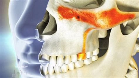 Sinusitis Pain In Teeth Teethwalls