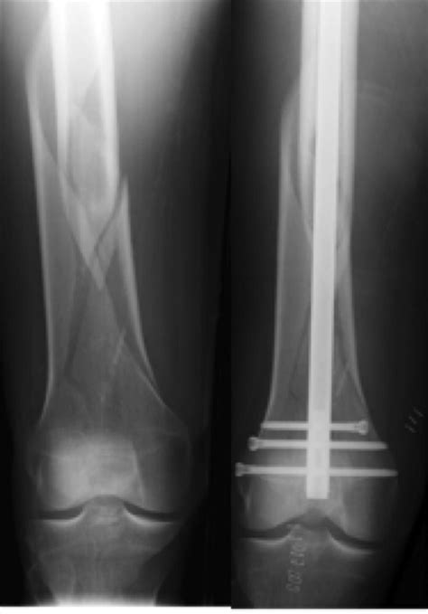 Femoral Shaft Fractures Trauma Orthobullets