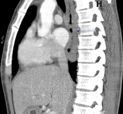 Computed Tomography Sagittal Section Shows Dilated And Fluid Filled Download Scientific Diagram