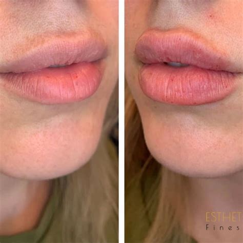Perfect Lip Filler Technique