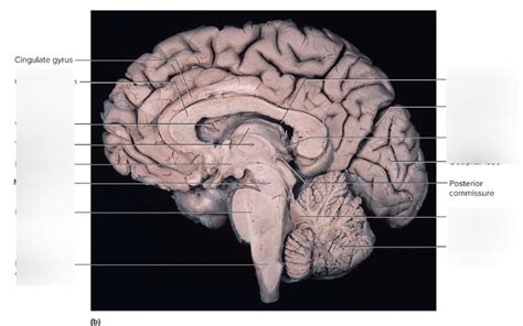 Cadaver Sagittal Brain Section Diagram Quizlet